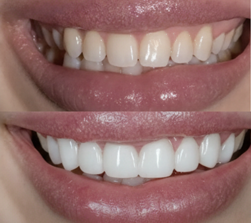 Before After